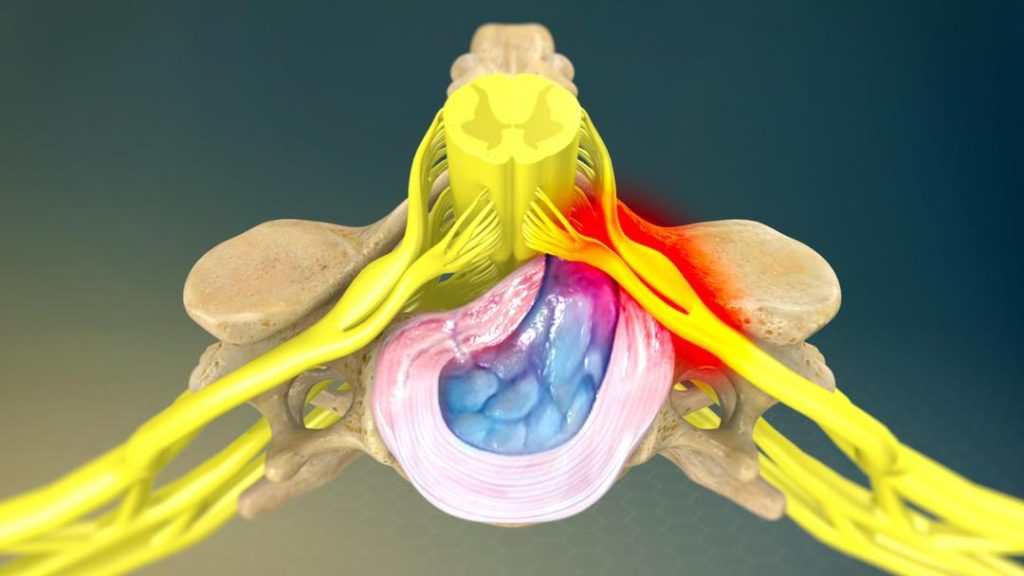 پارگی دیسک کمر چیست