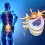 پارگی دیسک کمر چیست | همه چیز درباره پارگی دیسک کمر