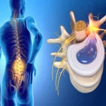کم آبی دیسک کمر چیست؟ - بررسی 0 تا 100 تاثیر آن بر ستون فقرات!