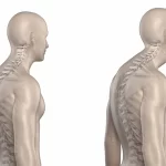 درمان قوز کمر در نوجوانان - راهکارهای 100 درصد کاربردی