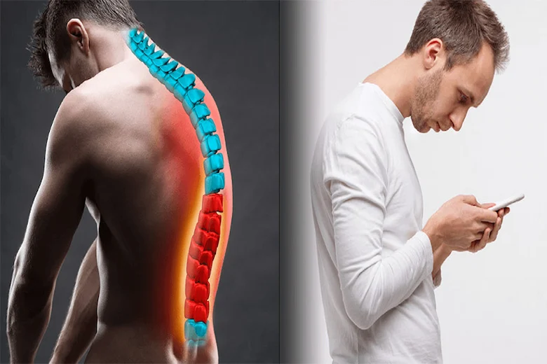 تصویری از کیفوز کمر در نوجوانان