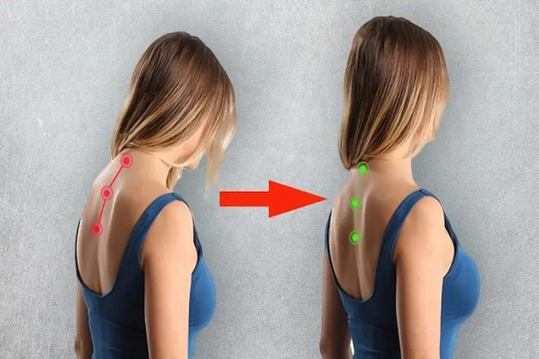 تصویری از درمان قوز گردن در کودکان