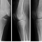 درمان دررفتگی کشکک زانو - بررسی 6 راهکار طلایی!