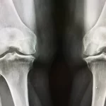 آرتروز زانو چیست؟ - بررسی 0 تا 100 راهکارهای درمان