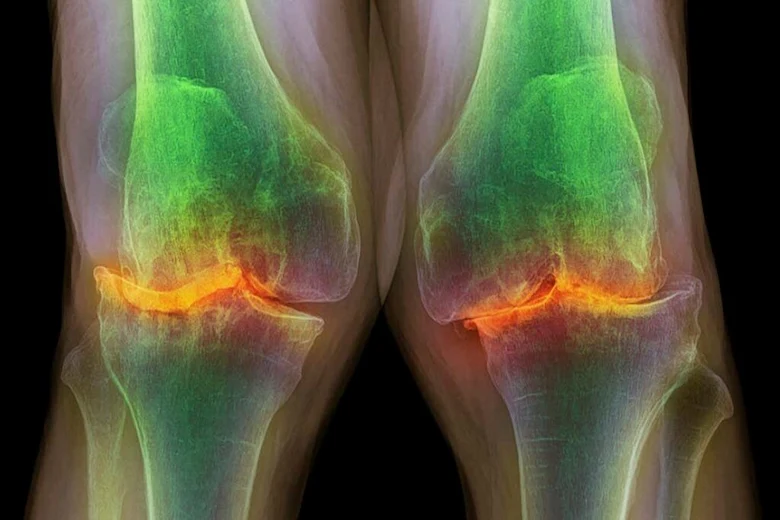 تصویری از آرتروز زانو
