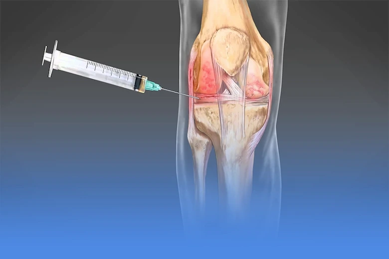تصویری از تزریق مایع روان کننده مفصل زانو