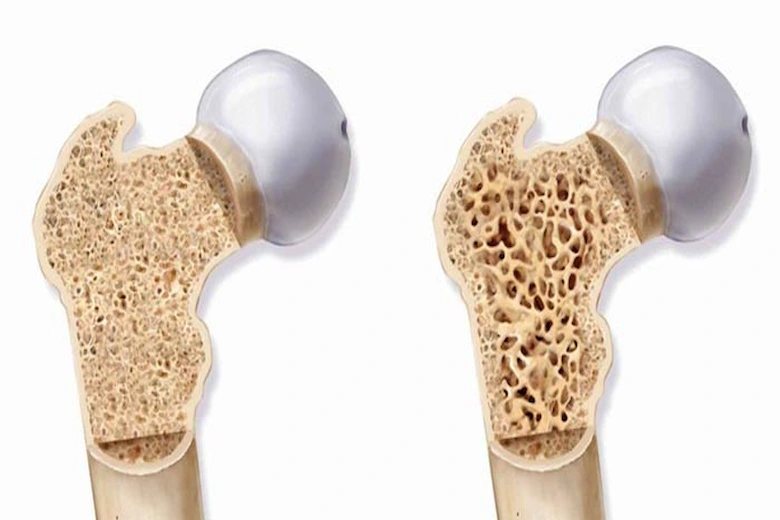 تصویری از علت پوکی استخوان