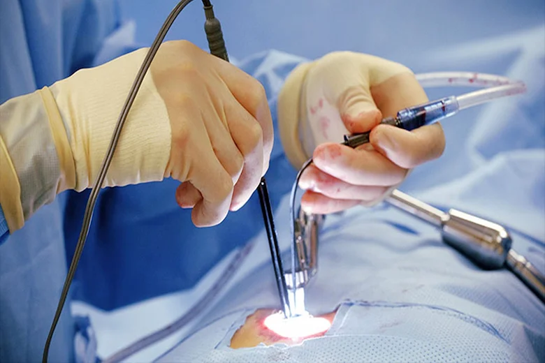 تصویری از جراحی دیسک کمر