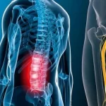 سیاتیک چیست؟ - بررسی 0 تا 100 علائم + راهکارهای درمان